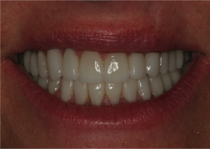 Kim's smile after TMJ treatment and cosmetic dentistry.