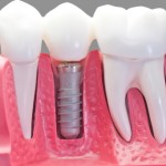 Capped Dental Implant Model