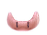 miniimplants1