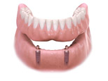 miniimplants2