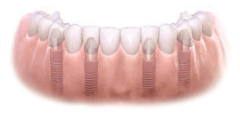 multipleimplants