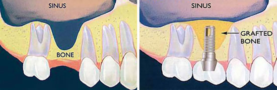 Sinus Lift